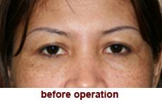 plastic-surgery-blepharoplasty